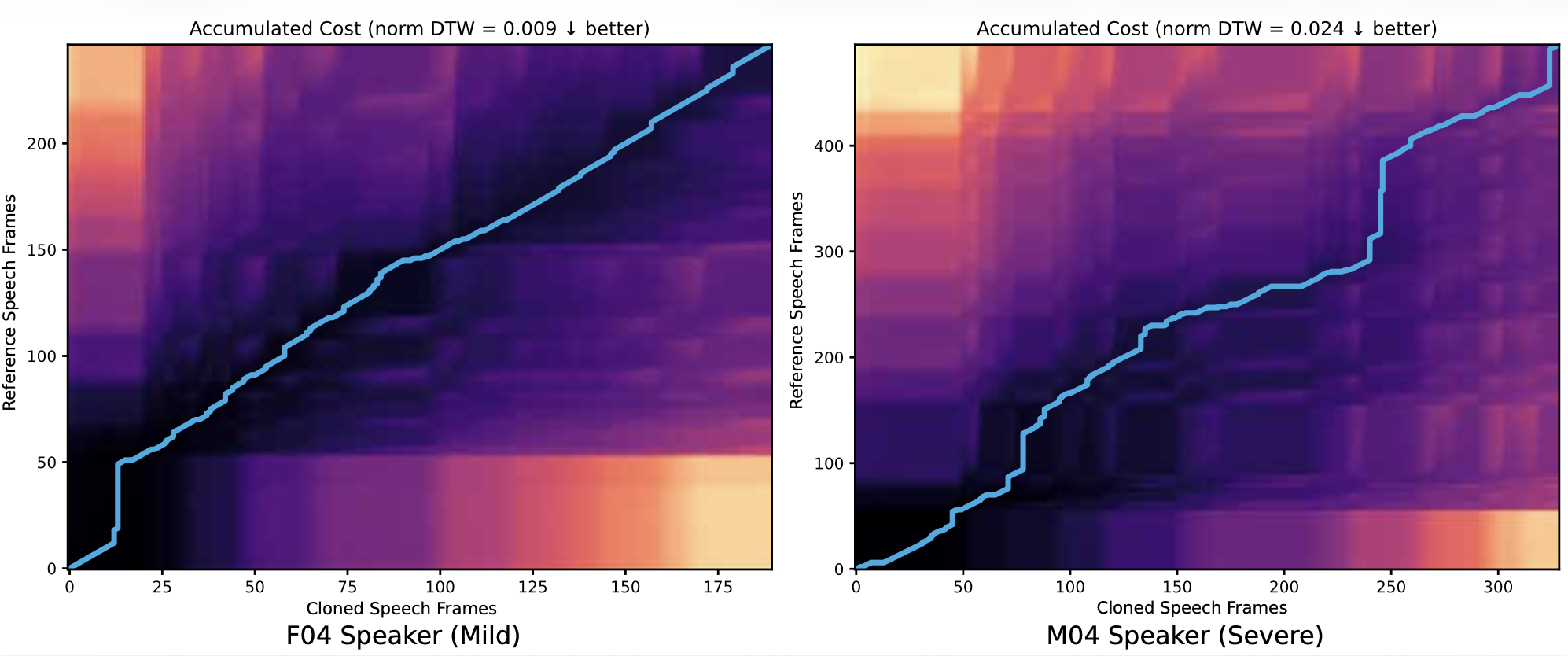 DTW alignment: mild dysarthria smoother path, severe shows more jitter.